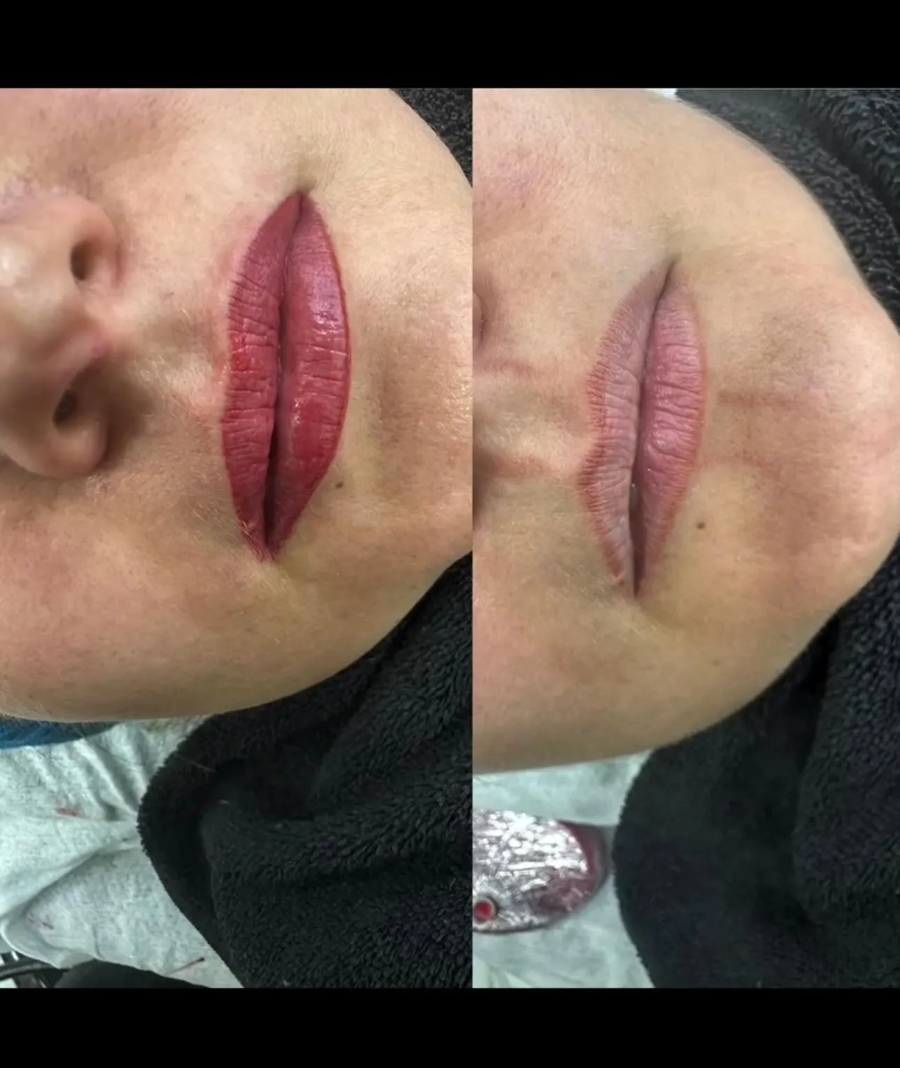 Lippenpigmentierung — Links vorher, rechts nachher.